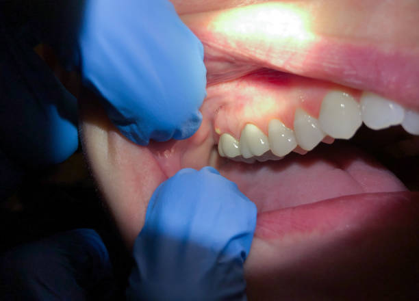 Best Emergency Gum Pain Relief  in Fairfield Beach, OH